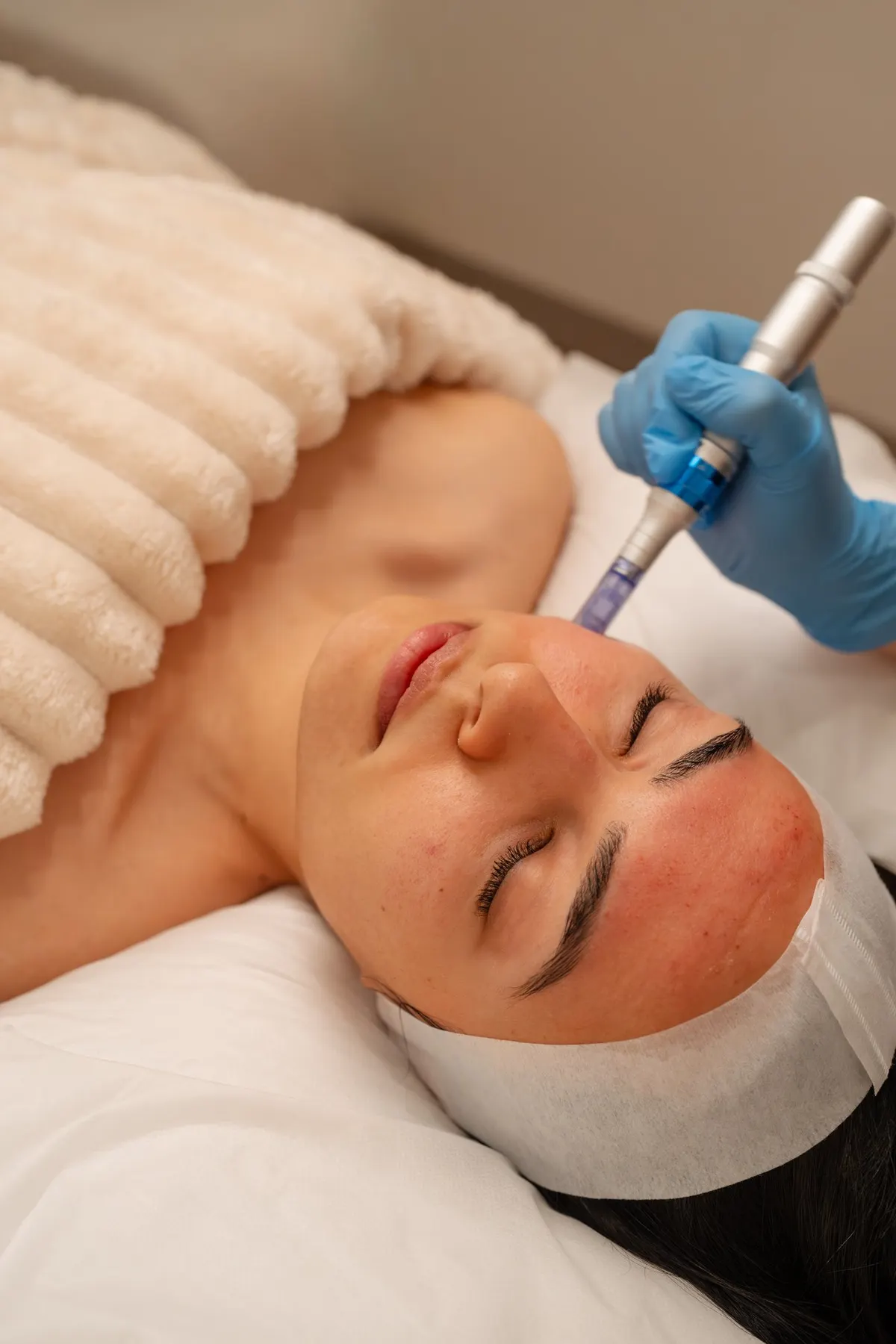 Rejuran skin needling treatment at Skin Therapy