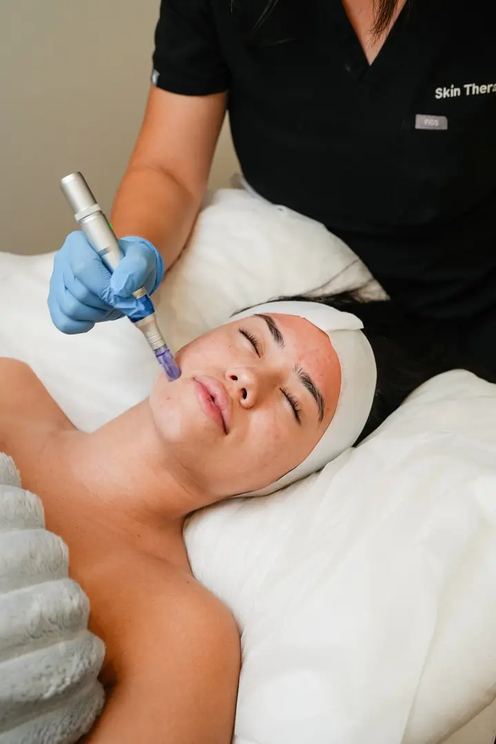 Dermapen 4 skin needling treatment at Skin Therapy