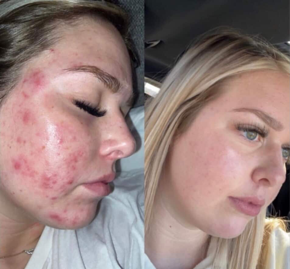 Skin Therapy client transformation 1