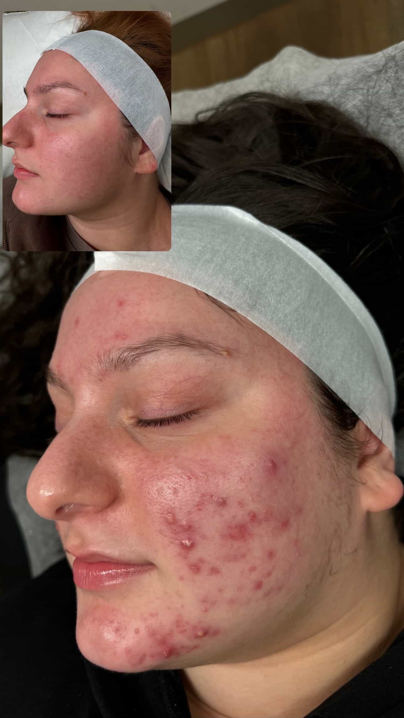 Skin Therapy client transformation 2