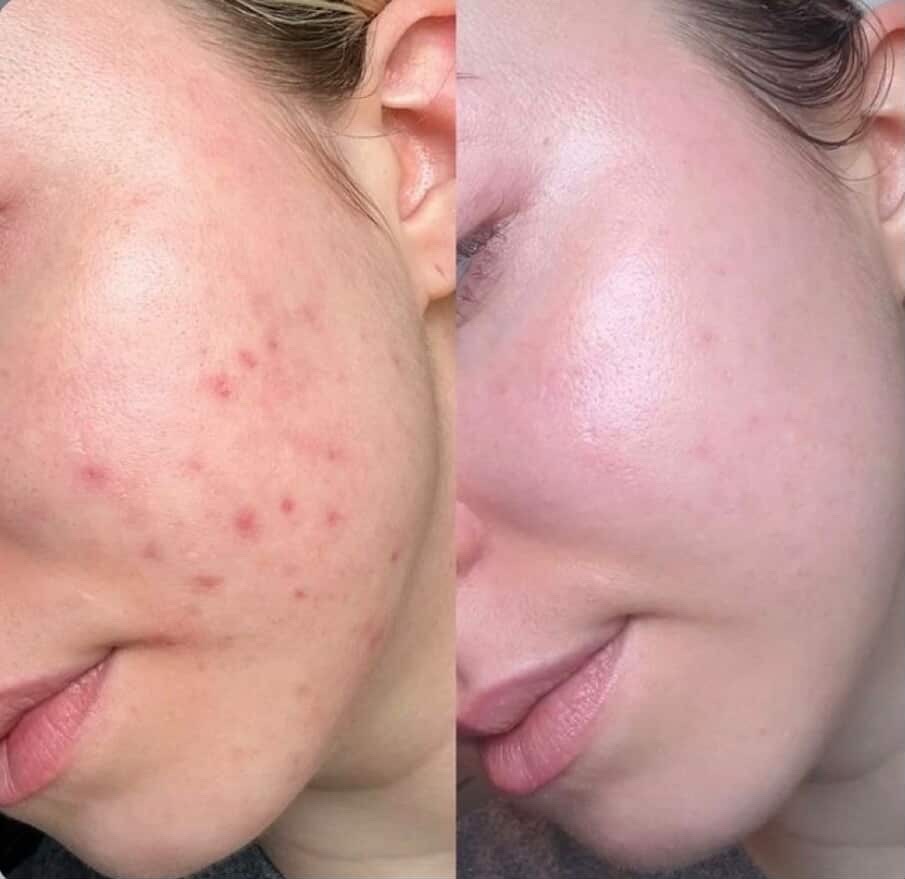 Skin Therapy client transformation 5