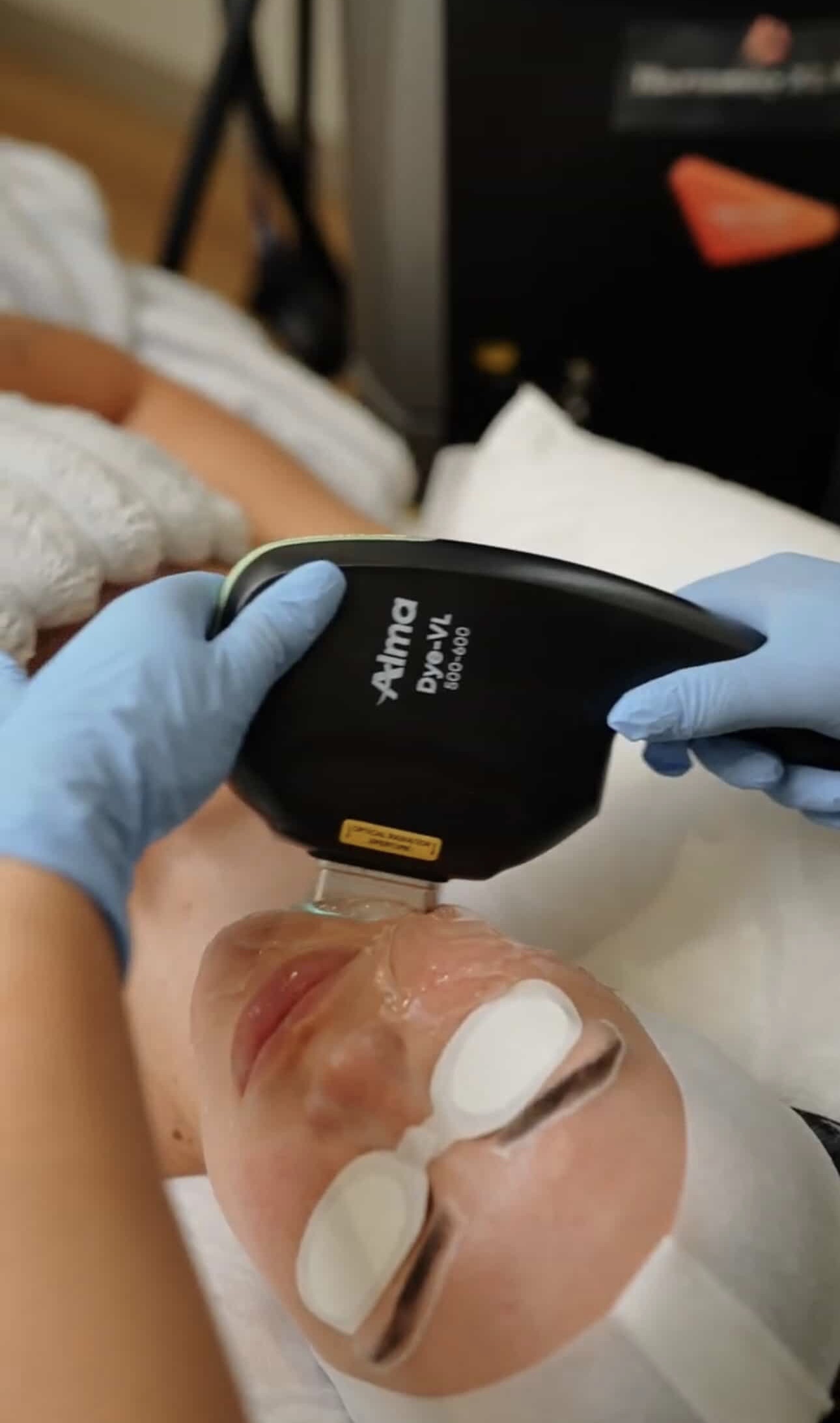 Dye-VL IPL
