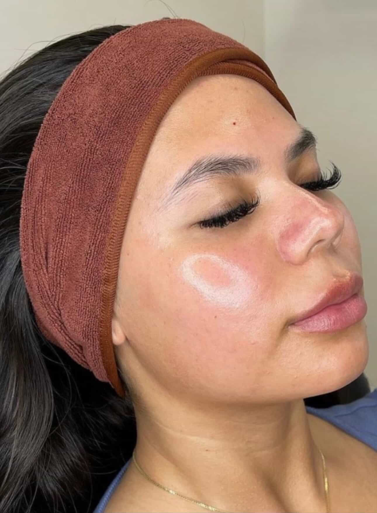 Rejuran Skin Needling, Full Face + LED