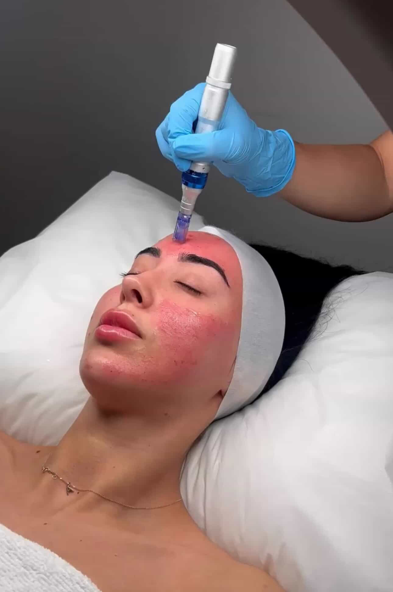 Skin Needling, Full Face + LED